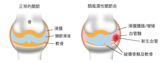 類風濕性關節炎和血管生成