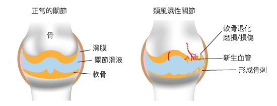 退行性關節炎和血管生成