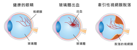 血管新生的玻璃體出血和牽引性視網膜脫離
