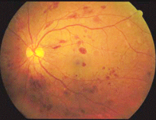 血管新生和糖尿病性視網膜病變