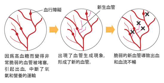 血行障礙引起病情惡化血行障礙引起病情惡化