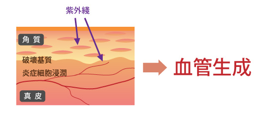 由紫外綫引起的血管生成血管新生和皮膚疾病