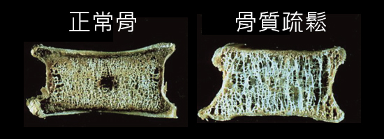 正常的骨和骨質疏鬆症的骨