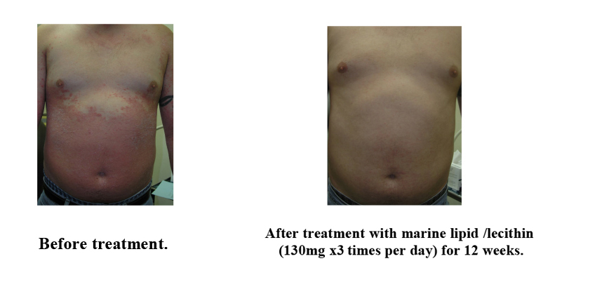 Difference of before and after treatment