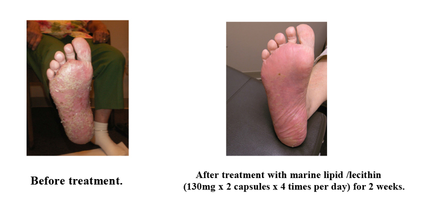 Difference of before and after treatment