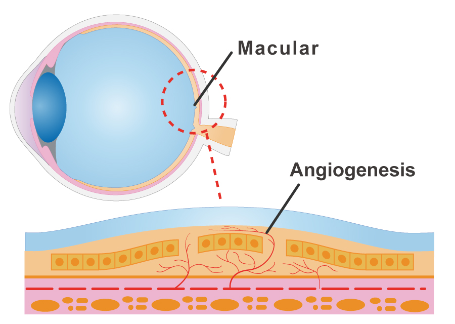 Age-related macular degeneration