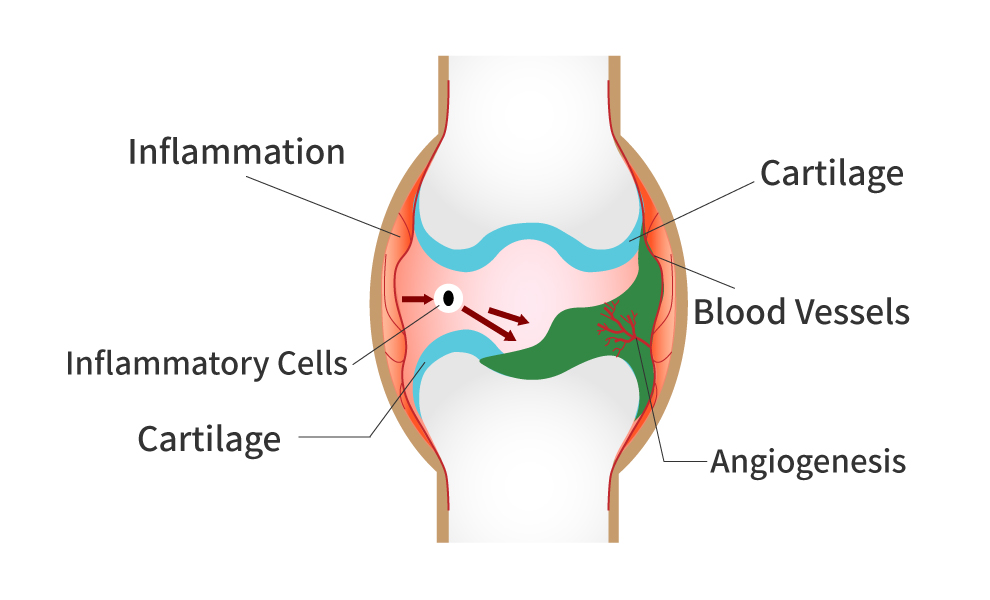 Angiogenesis in Rheumatoid Arthritis