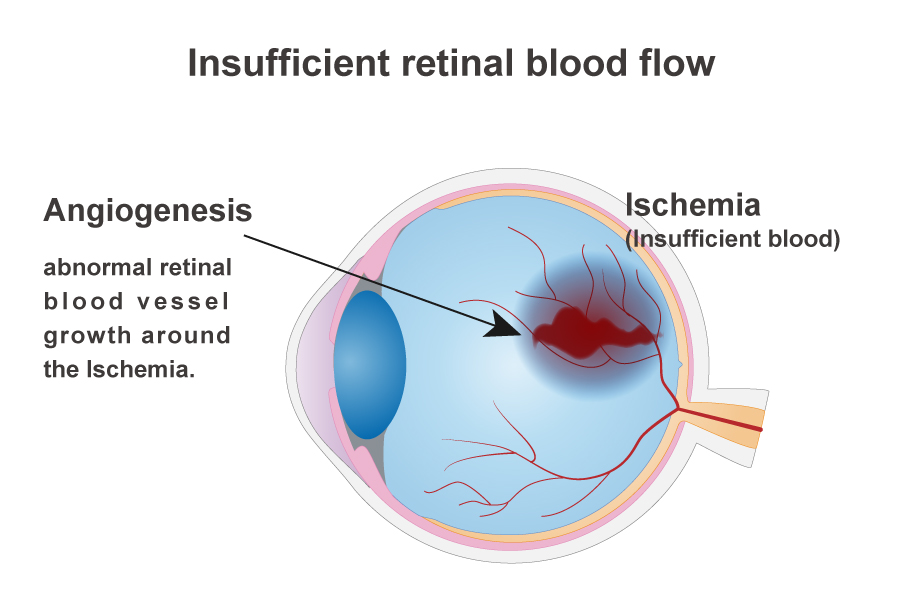 Diabetic retinopathy