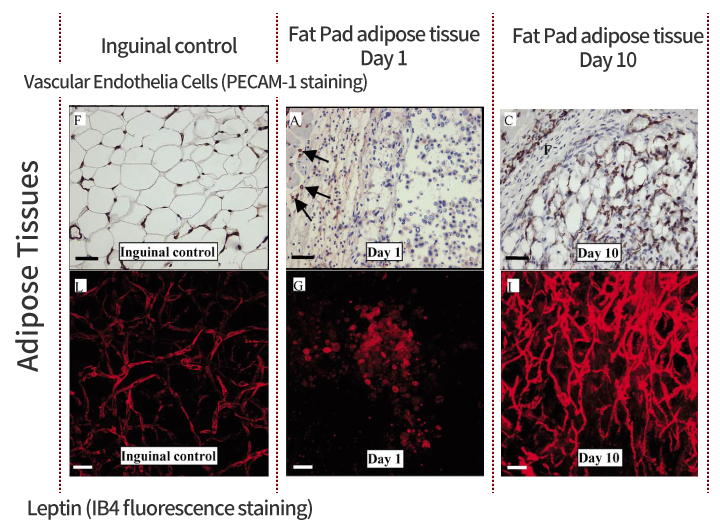 Relationship between Angiogenesis in Diabetic Retinopathy and obesity