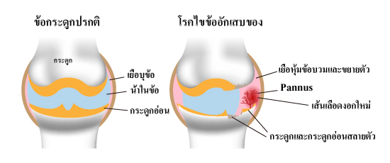 เส้นเลือดงอกใหม่กับโรคข้ออักเสบรูมาตอยด์