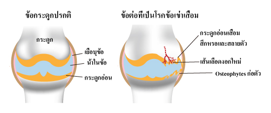 เส้นเลือดงอกใหม่กับโรคข้อเข่าเสื่อม