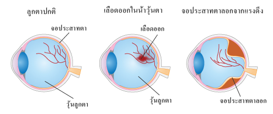 เลือดออกในน้ำวุ้นตาและจอประสาทตาลอกจากแรงดึง