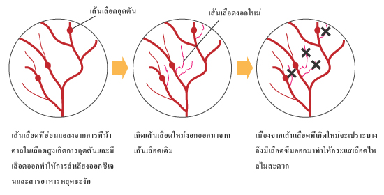 การทรุดลงของอาการของโรคที่ก่อให้เกิดเส้นเลือดอุดตัน