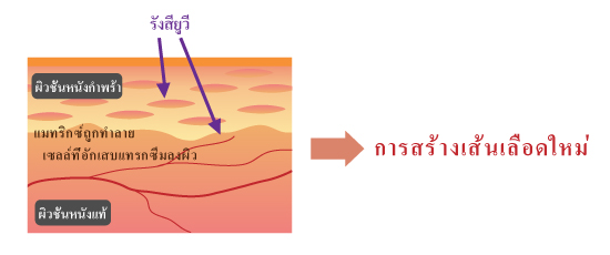 การเกิดเส้นเลือดงอกใหม่จากรังสียูวี