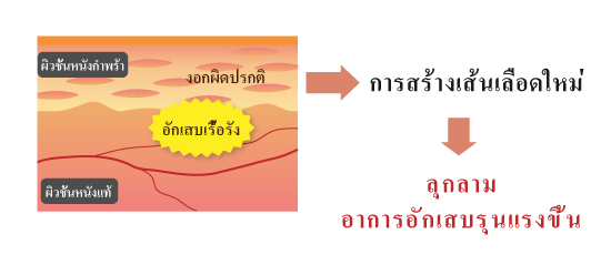 สภาพผิวหนังของผู้ป่วยด้วยโรคสะเก็ดเงิน