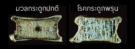 โรคกระดูกพรุน